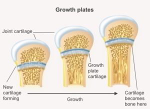 身長が伸びる理由、骨の成長板とは？